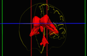 Brain Imaging in AHCRN